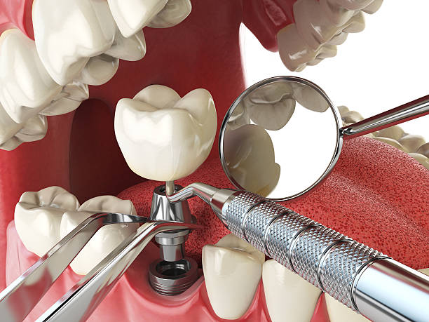 Best Emergency Treatment for Dental Infections or Abscesses in Fairforest, SC